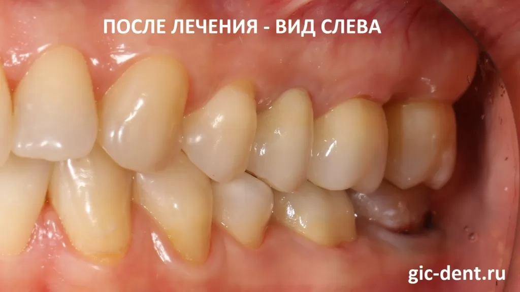 Финишные фото боковой проекции жевательных зубов. Вид слева.